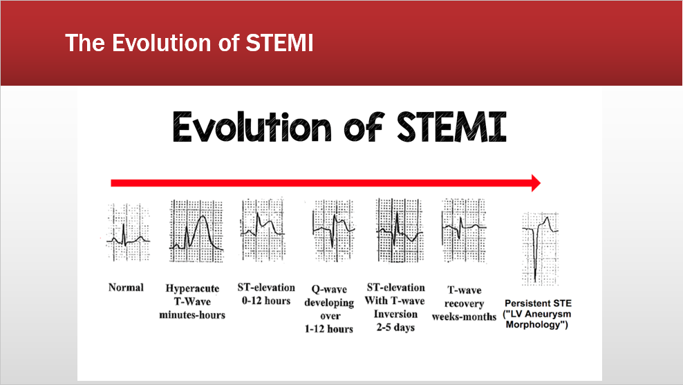 Evolution of STEMI